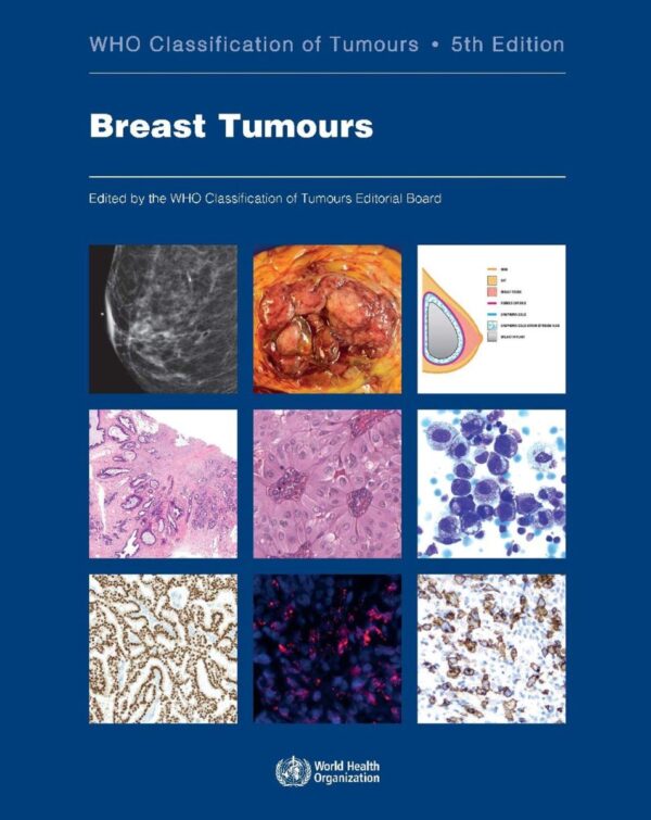 Who classification of Tumours of the Breast -0